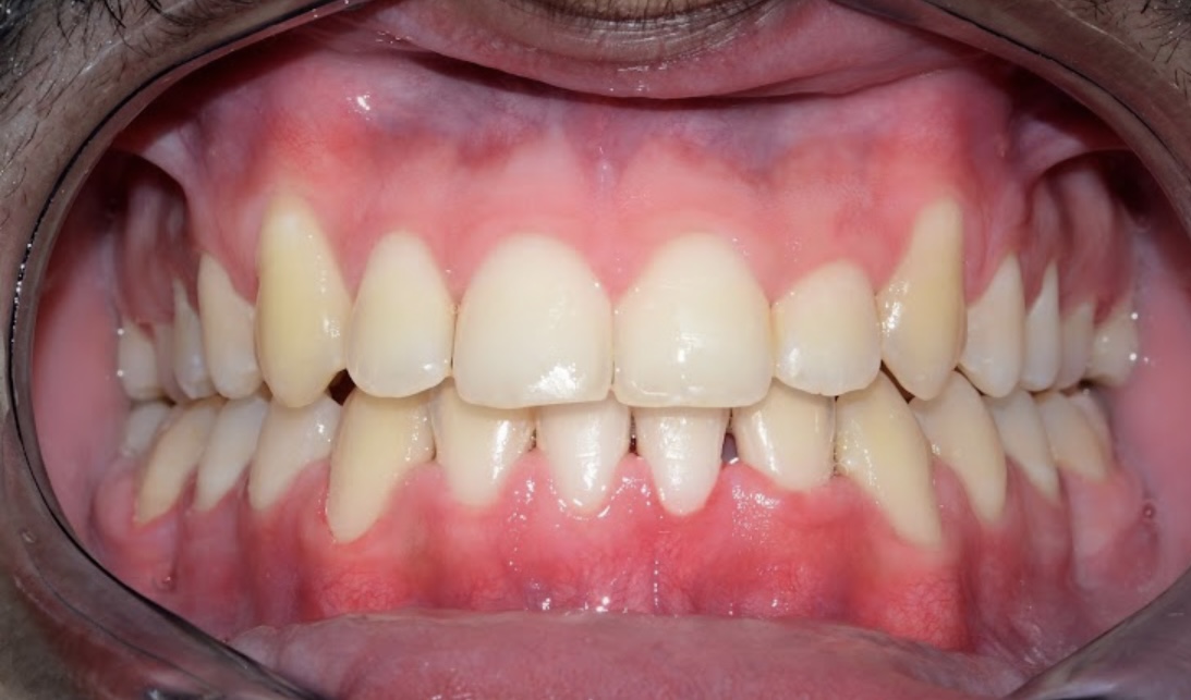 gingival colors 1